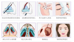 鼻尖整形需要多少钱