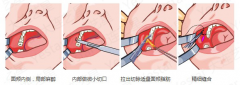 去颊脂垫手术是怎么做的