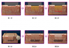 彩光嫩肤祛斑效果怎么样