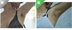 超微创腋臭去除法，让您告别狐臭烦恼