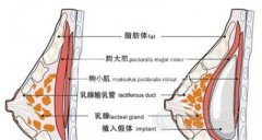 做好假体隆胸后怎样护理呢