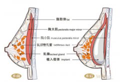 硅胶假体隆胸安全性高不高