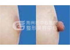 乳头内陷可以自行拔出吗