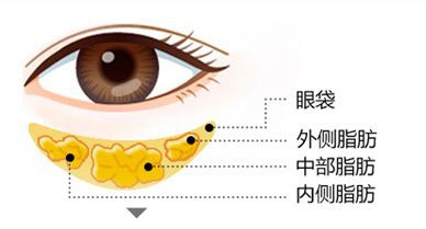 <b>荆州去眼袋手术效果好吗?祛眼袋要多少钱</b>