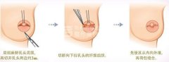 乳头凹陷的矫正方法有哪些