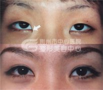 <b>开眼角手术的安全性如何?</b>